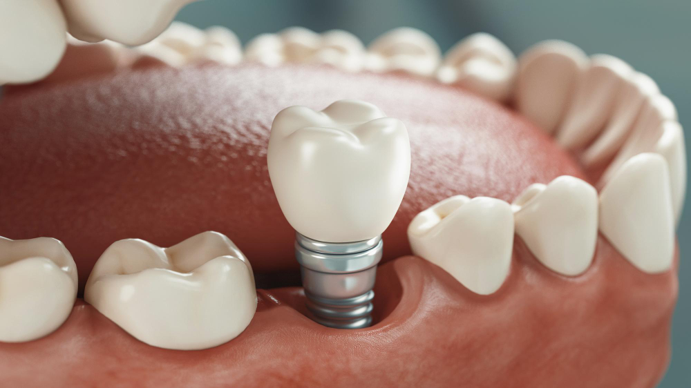 Dental Implants in Artesia