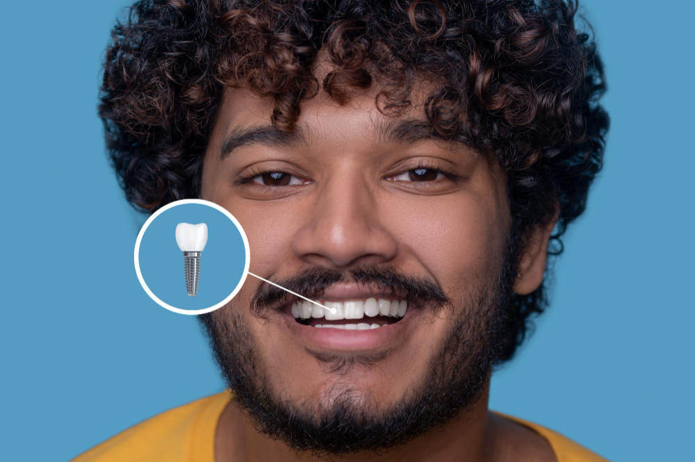 Implant Restoration in Artesia